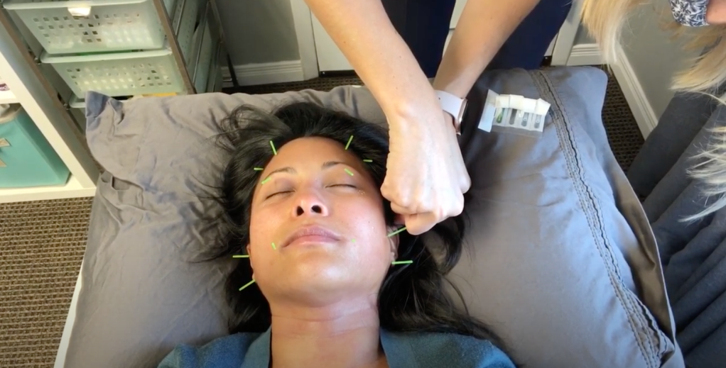Facial Rejuvenation Acupuncture&nbsp;Treatment